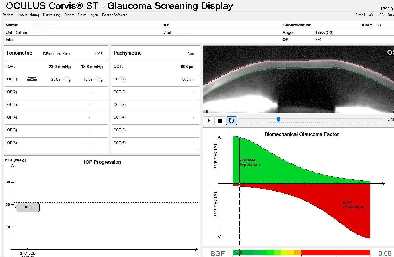 Messung des Augendruck und Auswertung unter Berücksichtigung der Biomechanik der Hornhaut