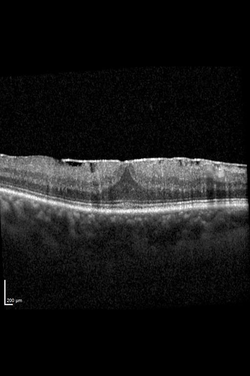 OCT Aufnahme einer epiretinalen Gliose