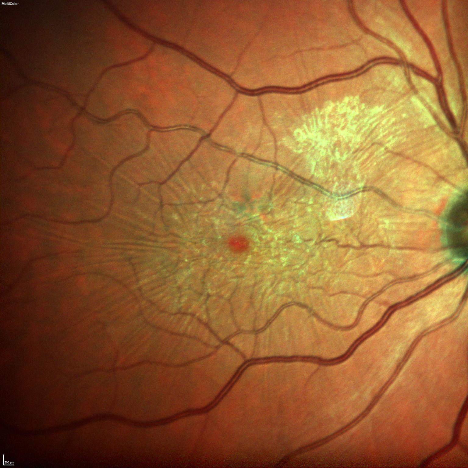 Multicoloraufnahme einer epiretinalen Gliose