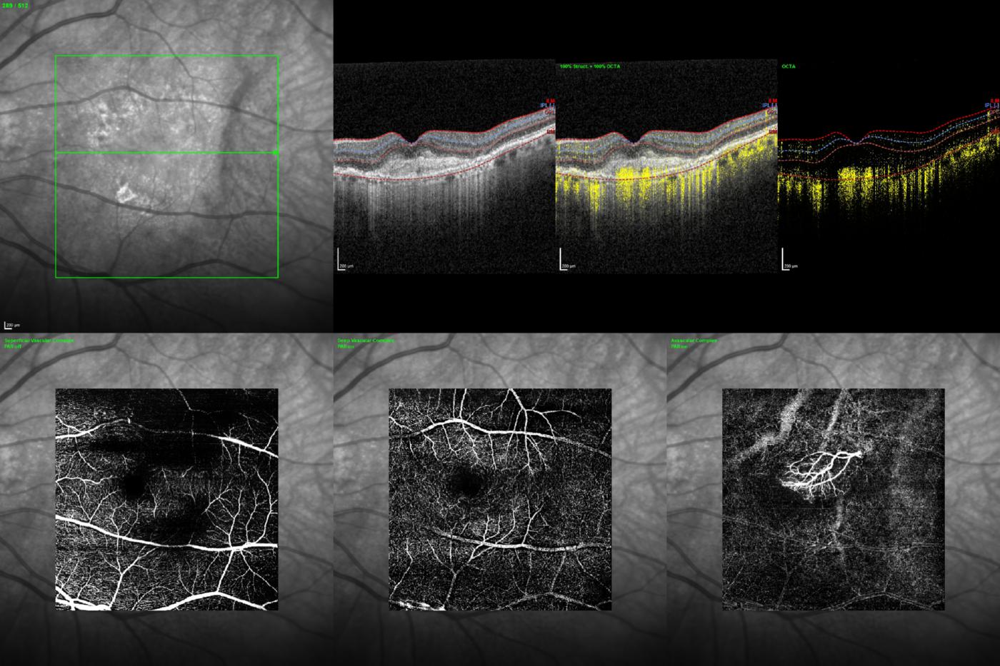 OCT-Angiographie einer feuchten AMD